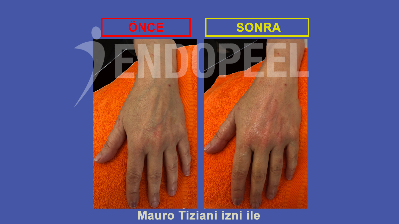 eller için endopeel gençleştirme
