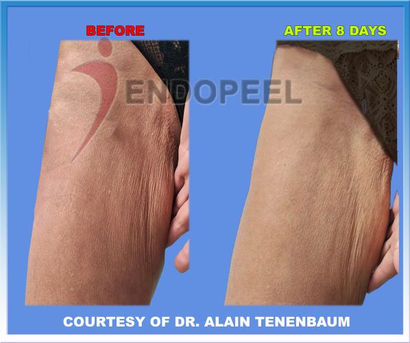 female thighplasty post lipoplasty