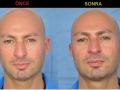 medical rhinoplasty endopeel