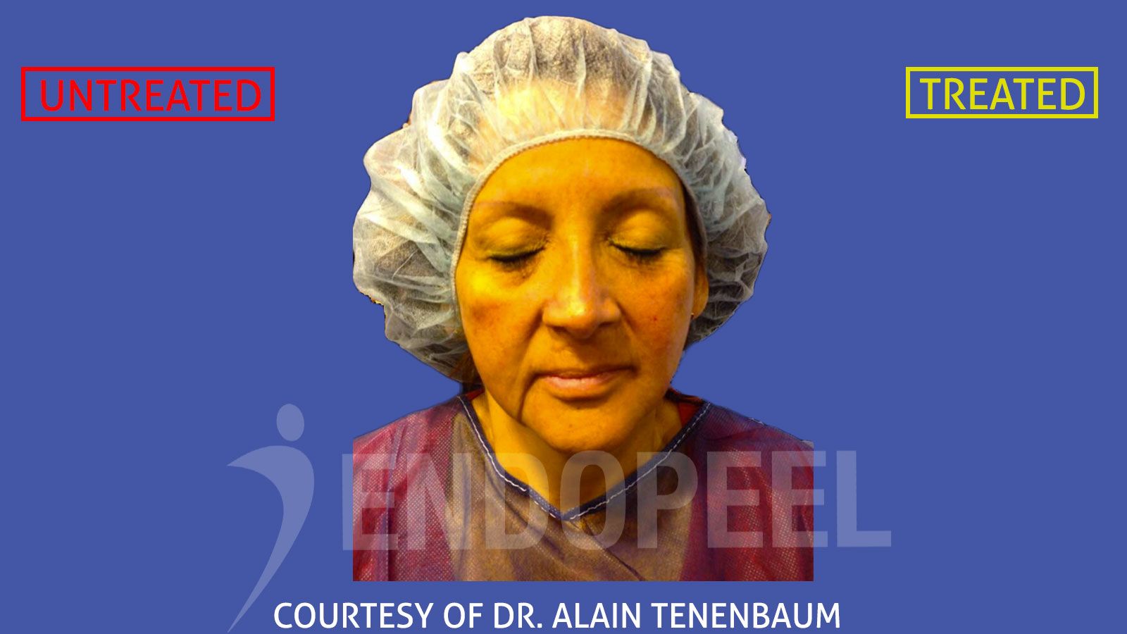 Y&uuml;z &ccedil;evresi Dr.Alain Tenenbaum