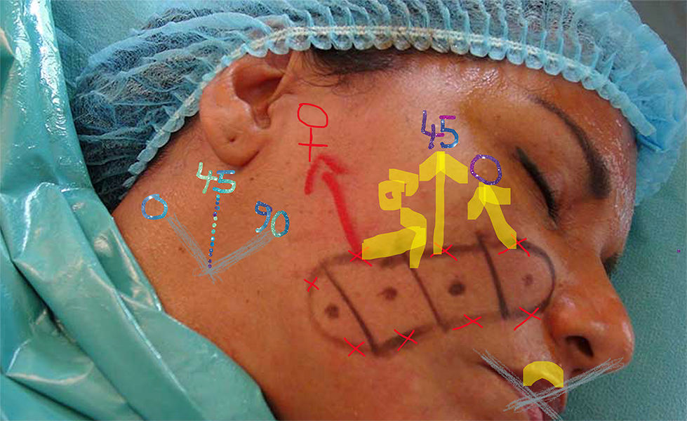 2. GÜN Endopeel Yüz