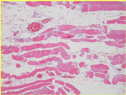 endopeel'den 25 dakika sonra düzensizlik görüldü