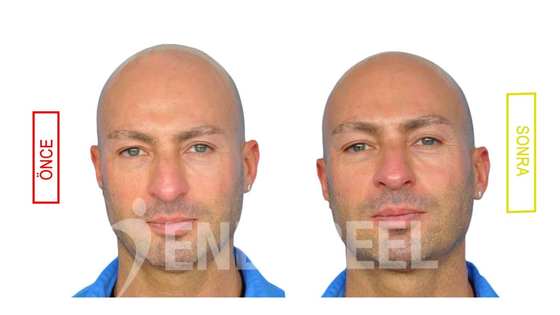 endopeel ile rinoplasti