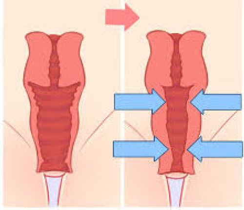 vajinal duvar sıkılaştırma