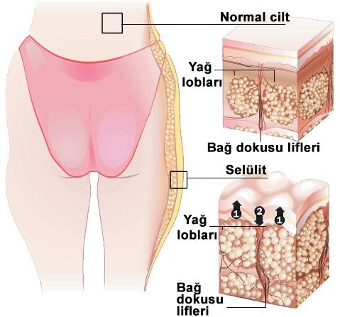 etiology of cellulitis