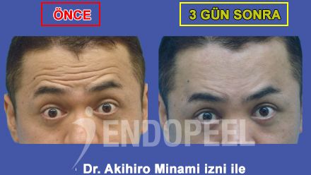 üst üçüncü yüz endopeel