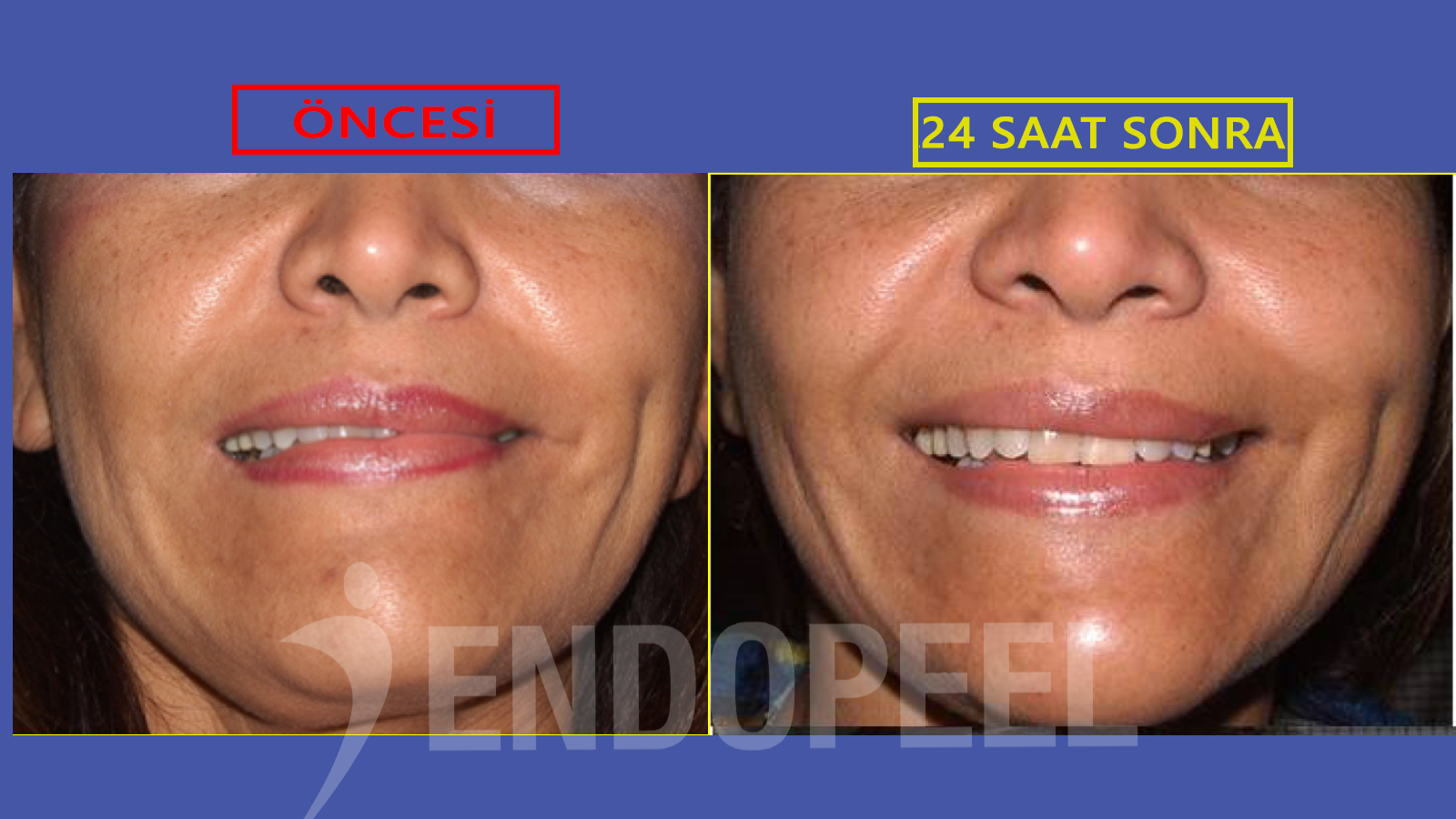 endopeel ve y&uuml;z felci