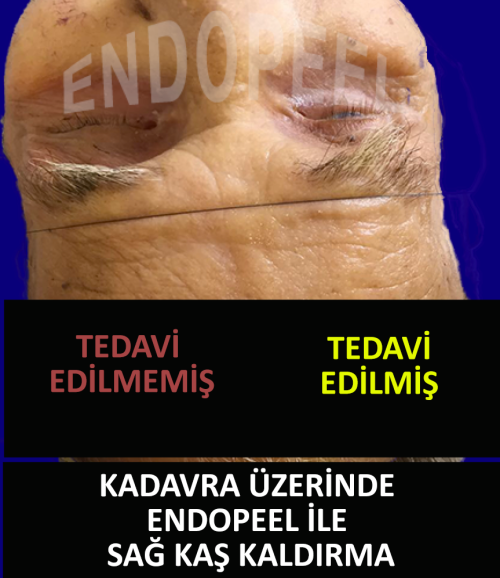 endopeel ile bir kadavra &uuml;zerinde kaş kaldırma