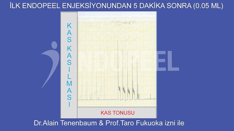 0.05 ml'lik 1. endopeel enjeksiyonundan 5 dakika sonra
