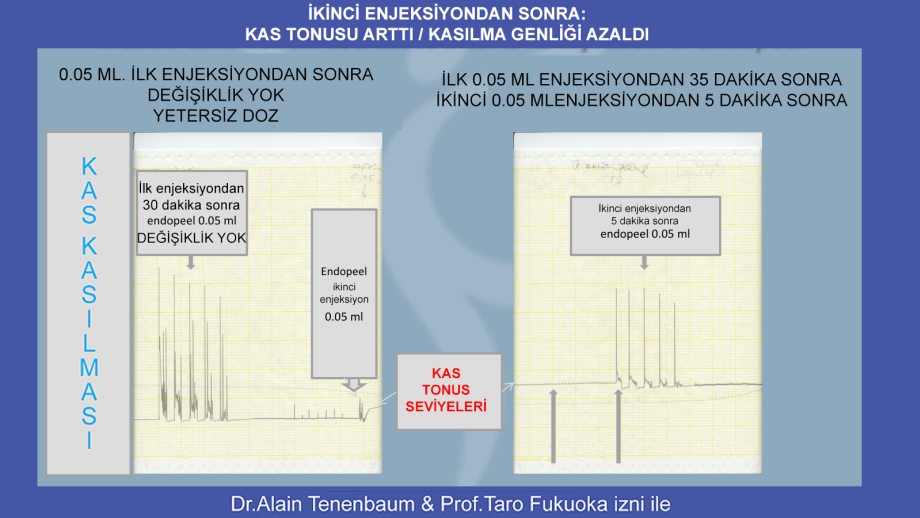 2. endopeel-enjeksiyonu