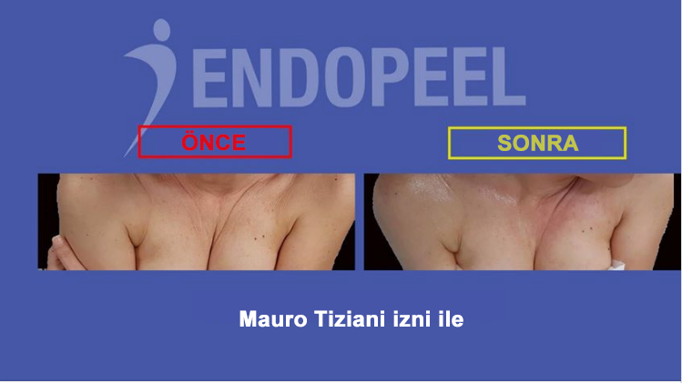 endopeel dekolte