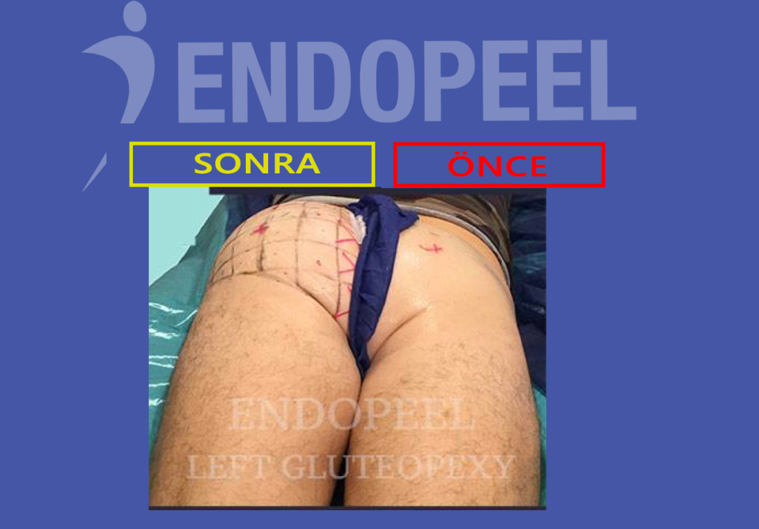 Endopeel ile travma sonrası atrofik izmaritlerin yeniden şekillendirilmesi