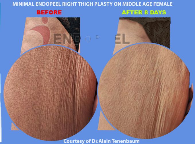 zoom + female thighplasty post lipoplasty