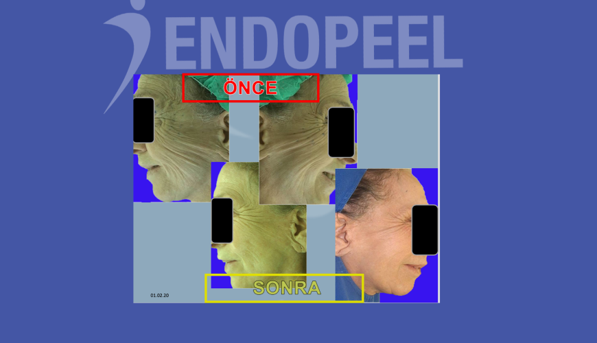 endopeel yaşlanma önleme