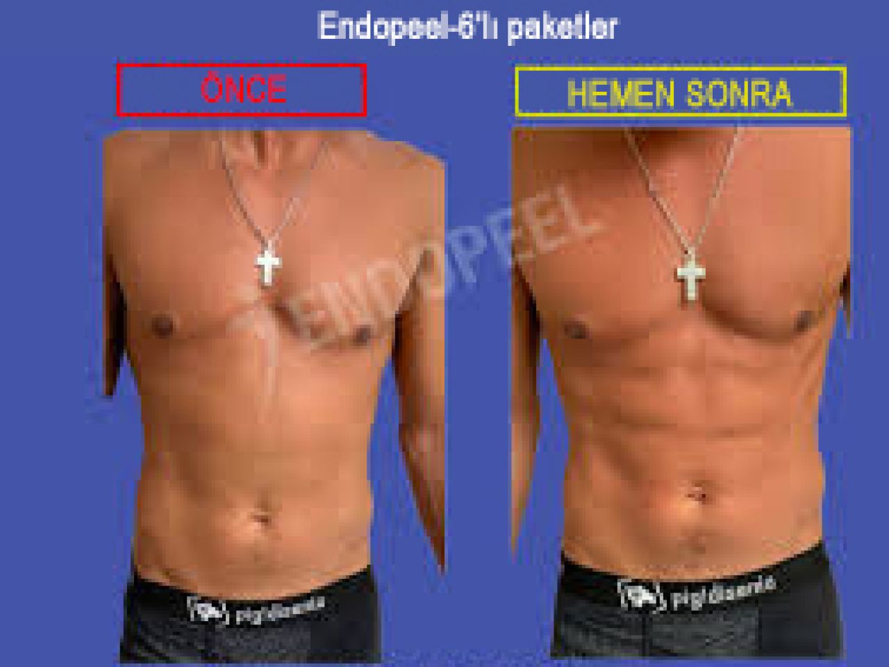 endopeel-six-packs
