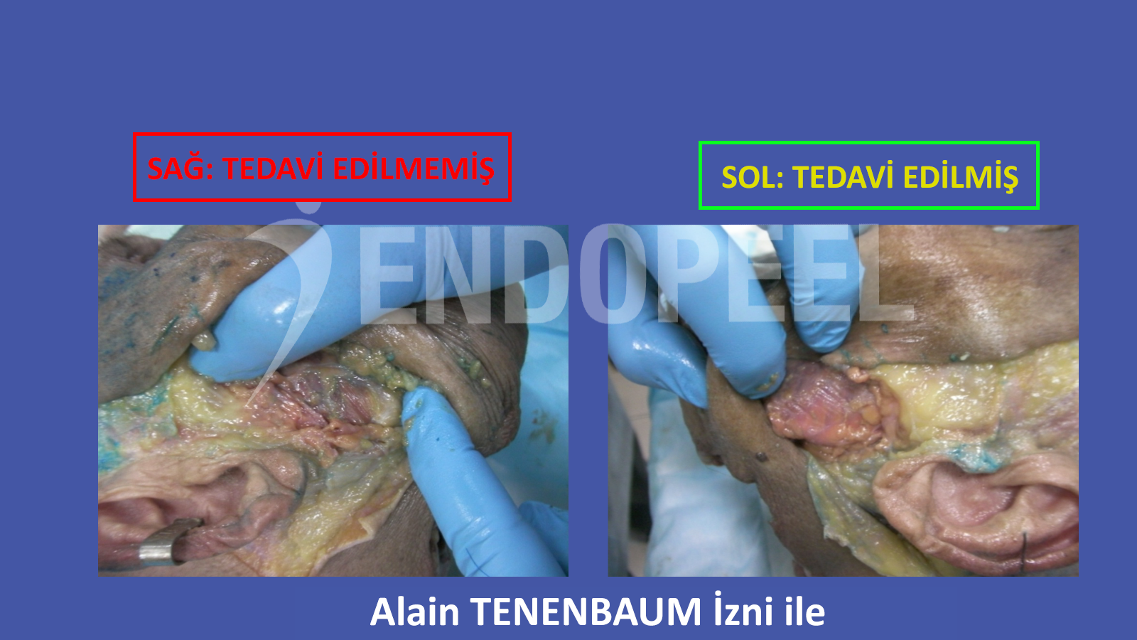 Aynı kadavra üzerindeki massetrelerin tek tarafı endopeel ile karşılaştırılması