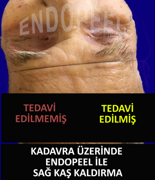 endopeel ile bir kadavra üzerinde kaş kaldırma