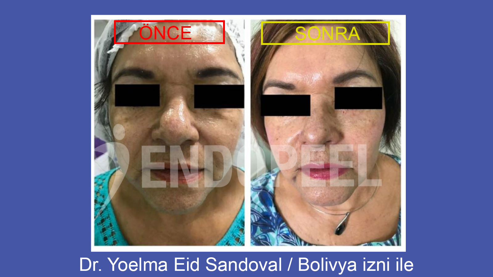 Eyebags Treatment and Endopeel